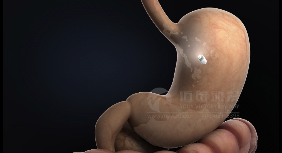 医学医疗三维动画 医学医疗三维动画